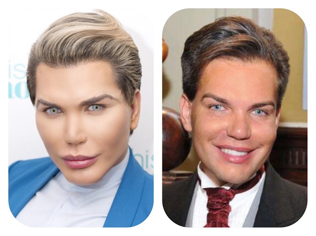 rodrigo_after_surgery Rodrigo’s multiple surgeries