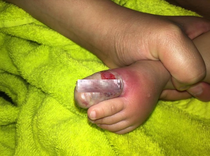 rashes are herptic whitlow rashes are Herptic Whitlow