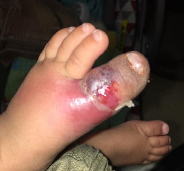 Small rash turned into blister