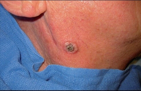 Melanoma cancerous Melanoma (cancerous