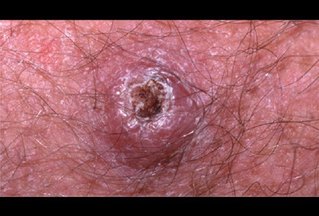 Squamous cell carcinoma Squamous cell carcinoma