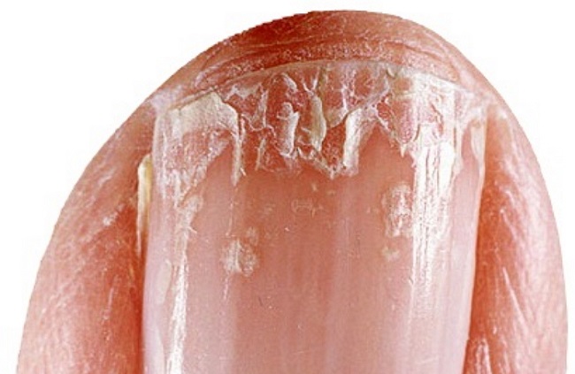 Brittle Nails Brittle Nails