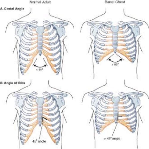Thirteenth rib. Thirteenth rib