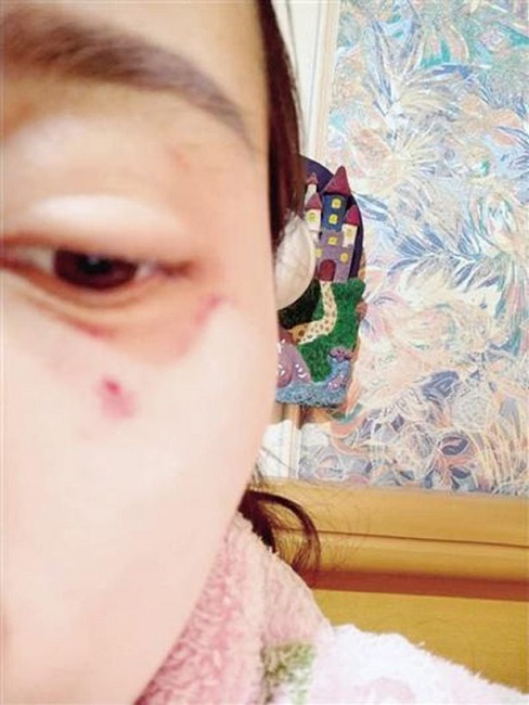 Li suffered fractures and injuries Li suffered fractures and injuries