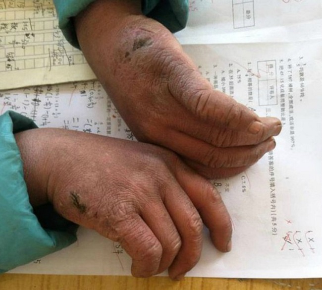 Snowflake boy studies in third grade at Zhuanshanbao primary school in Xinjie Township, China Snowflake boy studies in third grade at Zhuanshanbao primary school in Xinjie Township, China
