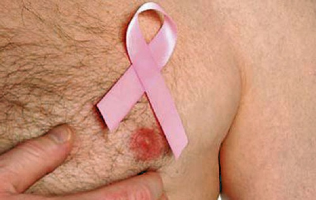 13 Surprising Symptoms of Male Breast Cancer You Should Never Ignore