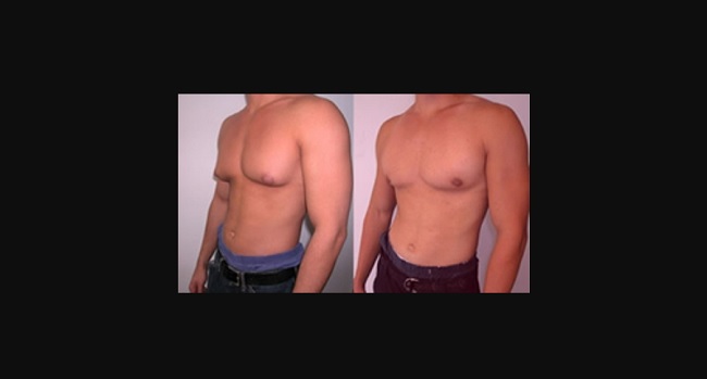 Adopt a healthier lifestyle and diet Adopt a healthier lifestyle and diet