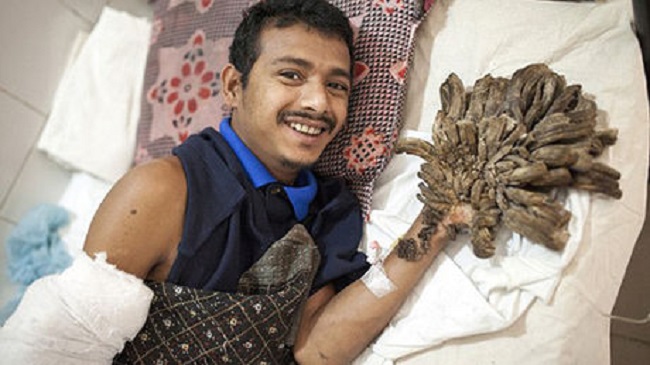 Another Bangladeshi girl was seen suffering from same condition Another Bangladeshi girl was seen suffering from same condition