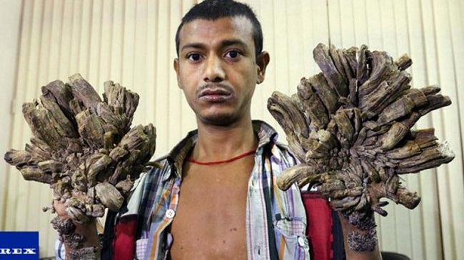 Bajandar is suffering from epidermodysplasia verruciformis