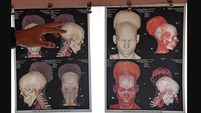 brain tumor scan brain tumor scan