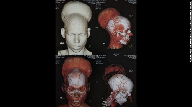 brain tumor scans brain tumor scans