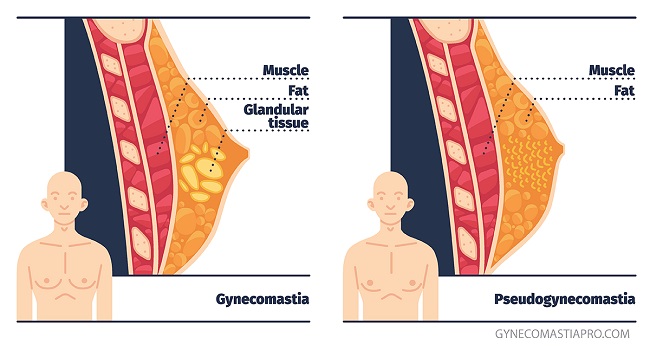 Do you have chest fat or gynocomastia Do you have chest fat or gynocomastia