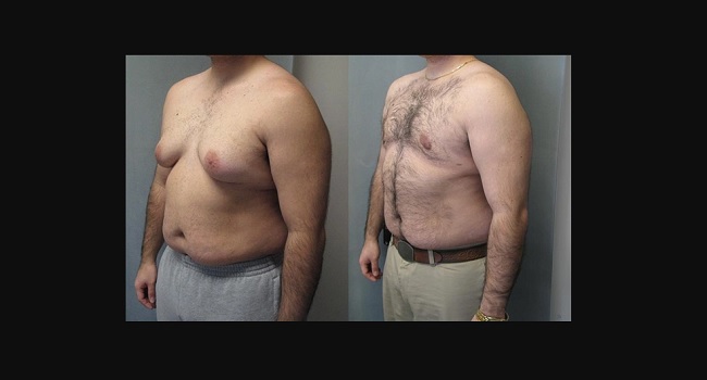 How to get rid of man boobs or chest fat How to get rid of man boobs or chest fat