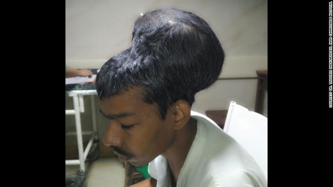 largest brain tumor largest brain tumor