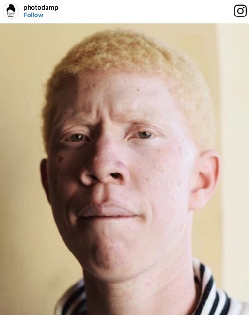 Albino from Venezuela Albino from Venezuela