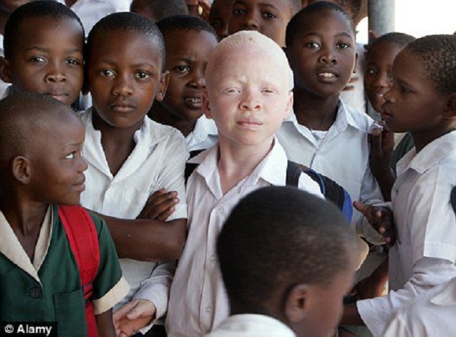 Albinos are hunted in Kenya Albinos are hunted in Kenya