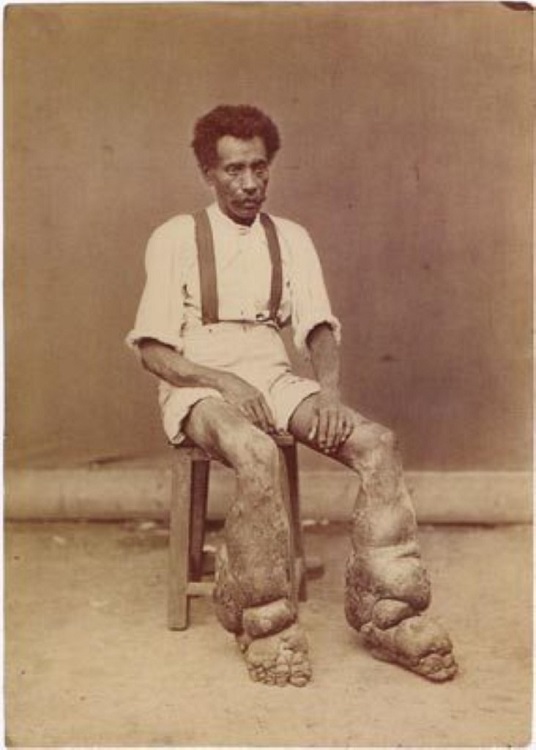 Elephantiasis Elephantiasis