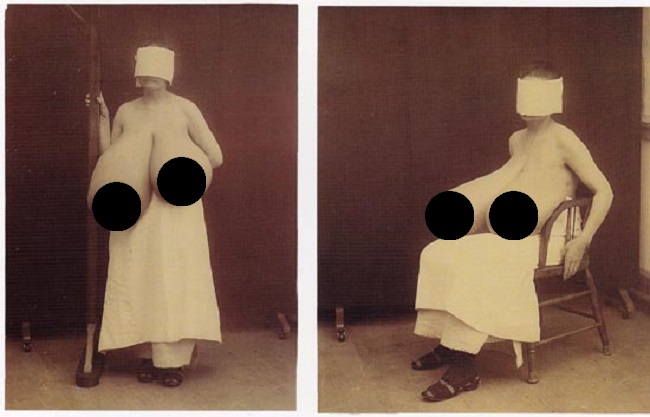 Enlarged Bosom Enlarged Bosom