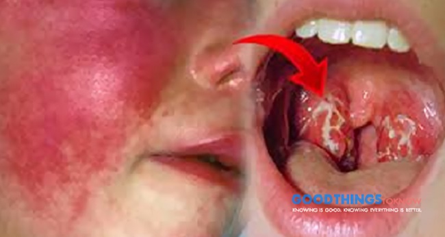 How scarlet fever is treated How scarlet fever is treated