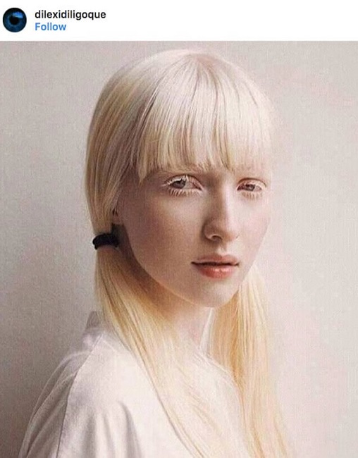 lbinism Europe lbinism Europe