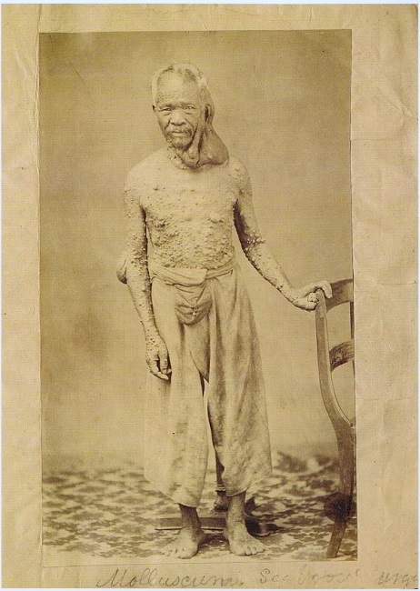 Neurofibromatosis Neurofibromatosis