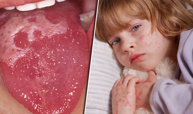 symptoms of scarlet fever