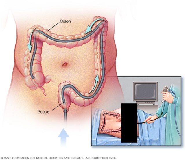 colonoscopy colonoscopy