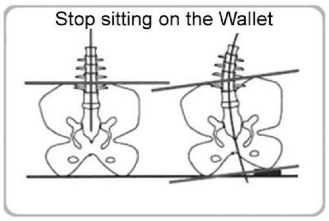 If side bending is allowed to continue, it leads to shortening of muscles