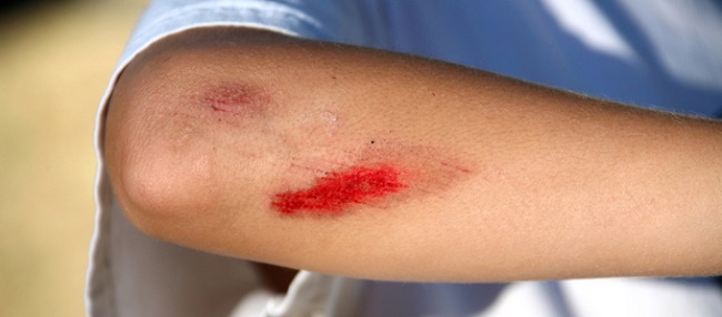 It is safe to lick your wounds It is safe to lick your wounds