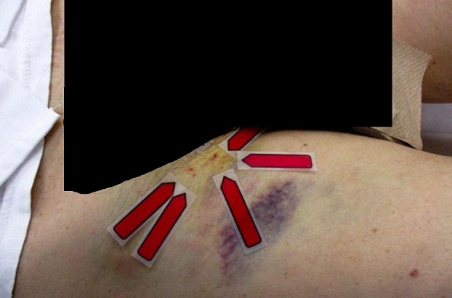 profusely bleeding groin profusely bleeding groin