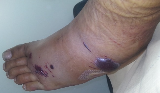 After-effects of stonefish venom After-effects of stonefish venom