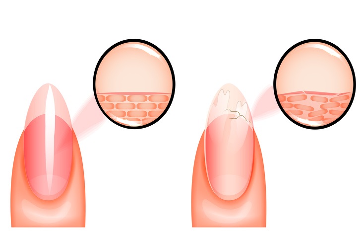 Brittle fingernails