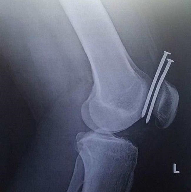 Nails embedded into knee Nails embedded into knee