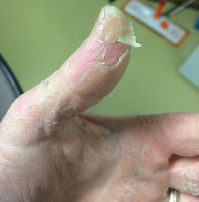 Peeling and Flaky Skin
