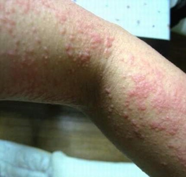 reflex cold urticaria
