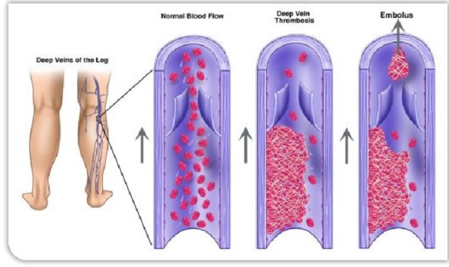 Types of blood clots Types of blood clots