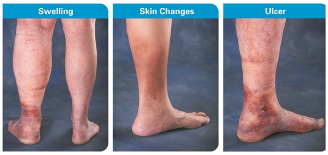 What is blood clot What is a blood clot