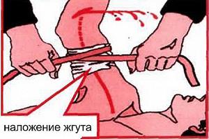 Cuts and Arterial Bleeding Cuts and Arterial Bleeding