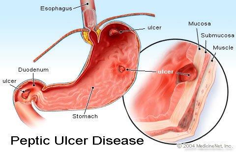 Stomach Ulcers Stomach Ulcers