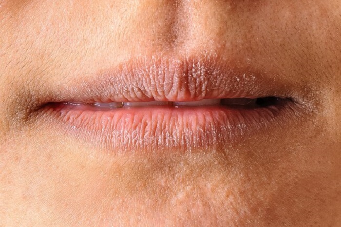Cracked, dry lips