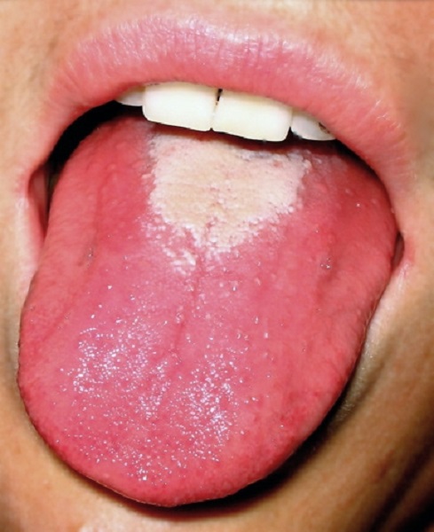 Sore and inflamed tongue