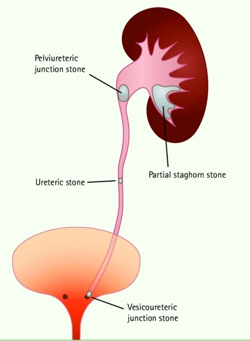 Tissue swelling is excruciatingly painful