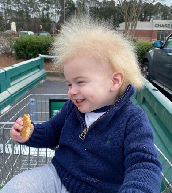 After getting a proper diagnosis, it was confirmed that Locklan’s indeed had uncombable hair syndrome