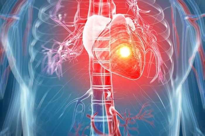 What causes heart attacks