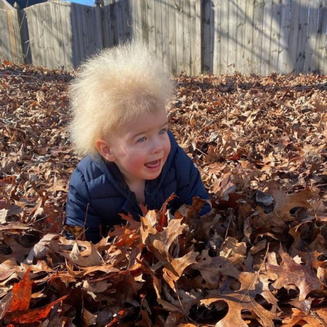 What is uncombable hair syndrome? 
