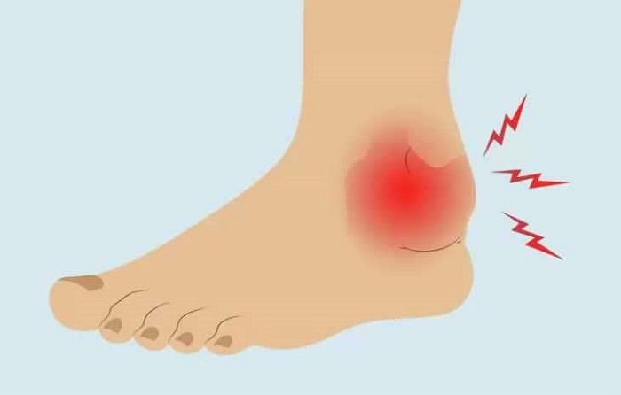 Your knee, ankle, and big toe become warm, red, or swollen