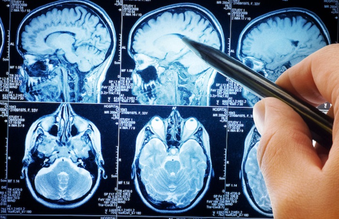 A.B. was diagnosed with a brain tumor. A.B. was diagnosed with a brain tumor