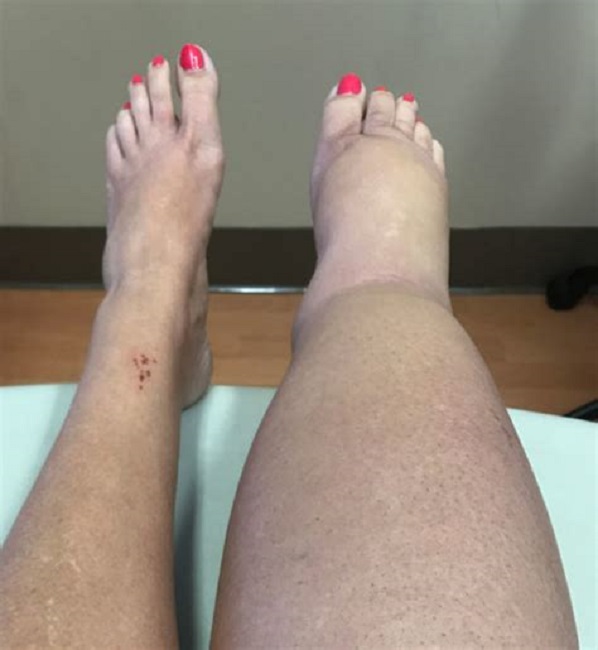 Lymphedema