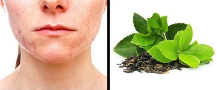 To get rid of acne scars: use green tea