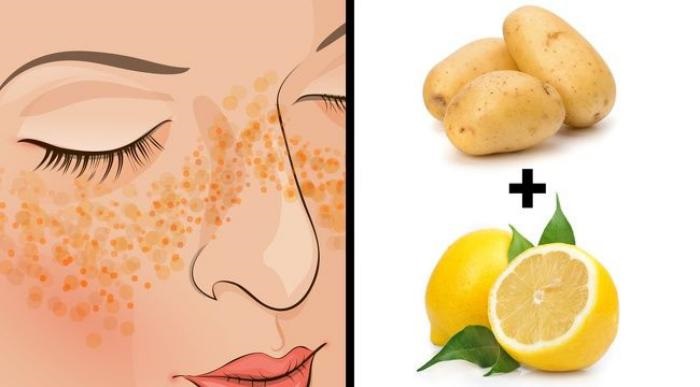 To reduce hyperpigmentation: use lemon juice with potatoes